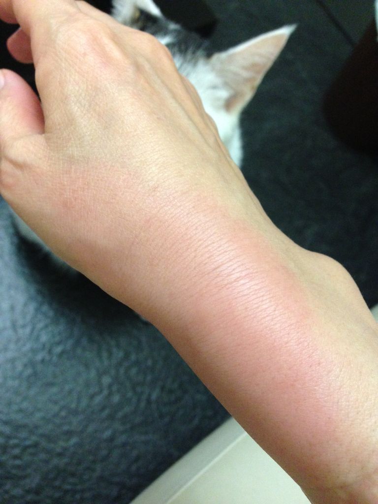 虫刺され まろぐ 虫刺され まろぐ