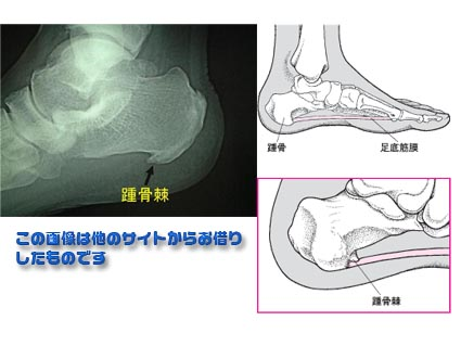 美しいものには 棘 トゲ がある 足底筋膜炎 オードリー スタイル 美しいものには 棘 トゲ がある 足底筋膜炎 オードリー スタイル