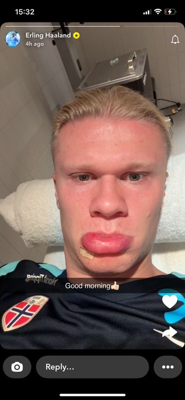 ◆悲報◆マン・シティFWハーランド、代表のチームバスのドアに顔をぶつけて下唇が明太子状態に!