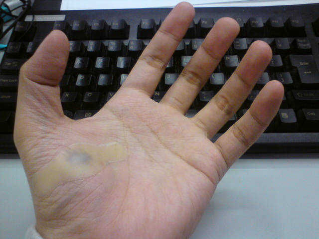 怪我した 941 Blog 怪我した 941 Blog