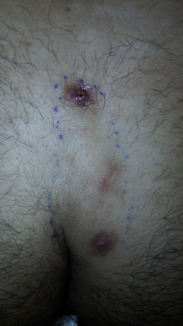 毛巣洞 大学病院受診編 画像あり注意 もとの毛巣洞 体験記