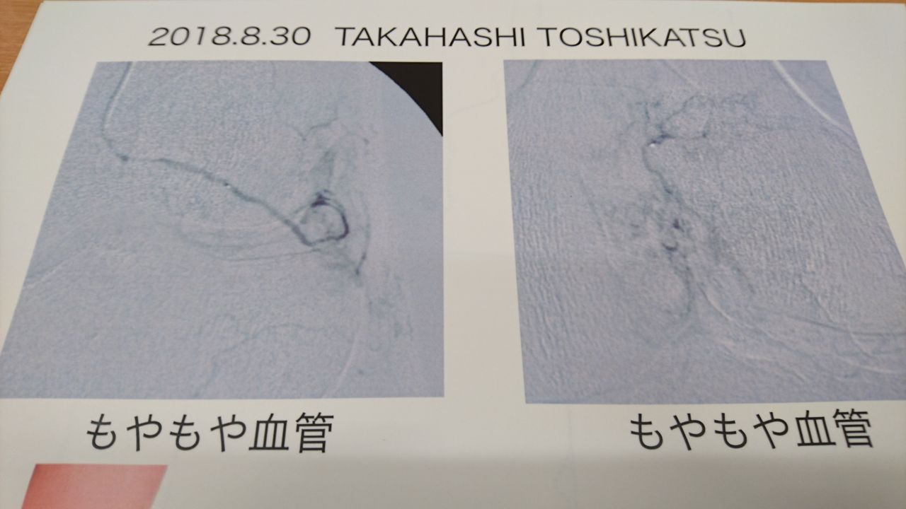 血管塞栓術 運動器カテーテル治療 百尺竿頭 b 血管塞栓術 運動器カテーテル治療 百尺竿頭 b