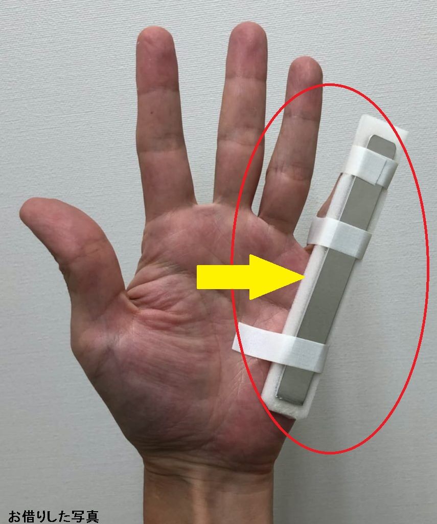 指の靭帯損傷お話し 怪我をしてから手術まで おじおばの奮闘記