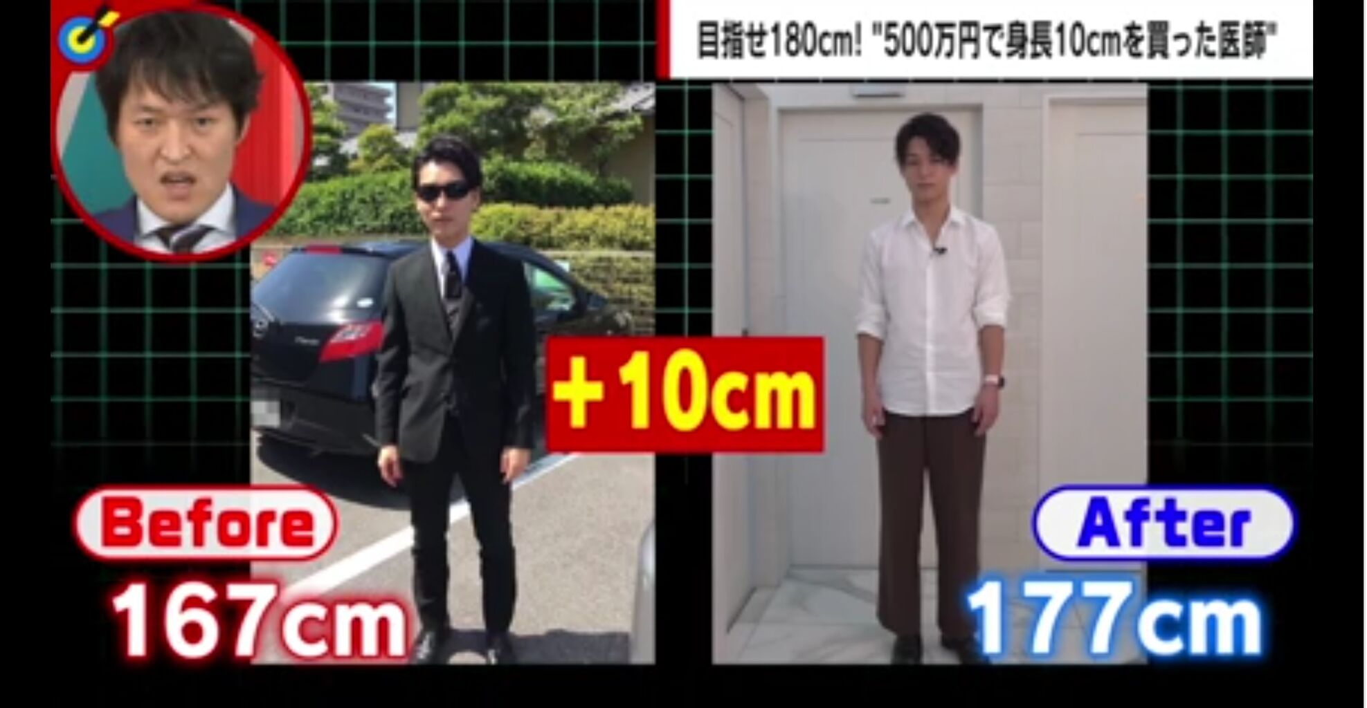 話題 身長167cmだった男性 500万円で10cm伸ばす手術して人生変わる 太もも スネの骨を人工的に一回折って 驚きの手法を公開 まとめるも情報局 話題 身長167cmだった男性 500万円で10cm伸ばす手術して人生変わる 太もも スネの骨を人工的に一回折って 驚きの手法を公開 まとめるも情報局