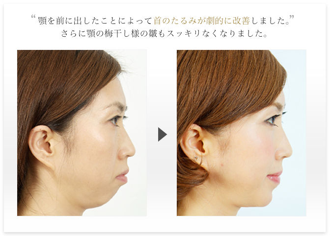 アゴ 顎がない 後退している人その4 あご 京都のネイルサロン口コミ情報