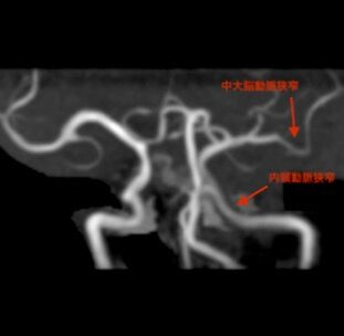 内頸動脈