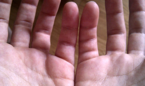 指に余分なシワ01