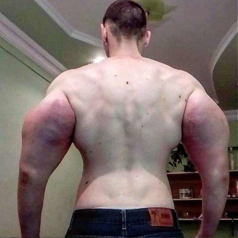 ロシア男性 筋トレは嫌いだけど太い腕が欲しい 注射で 偽の筋肉 をゲットするも批判殺到 らばq