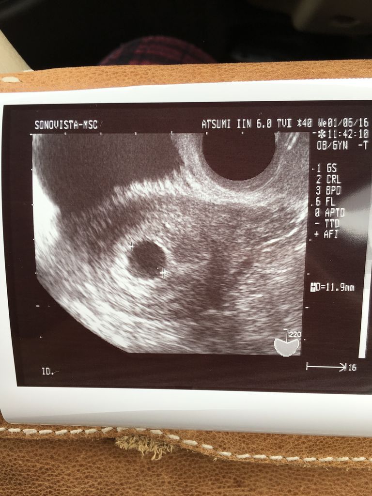 胎嚢 確認 後 流産