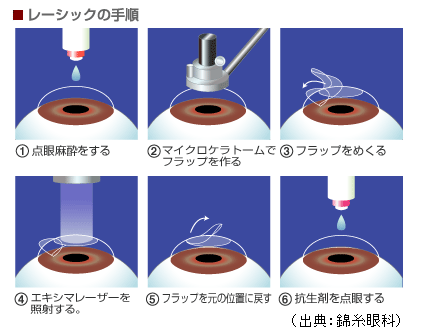 LASIK