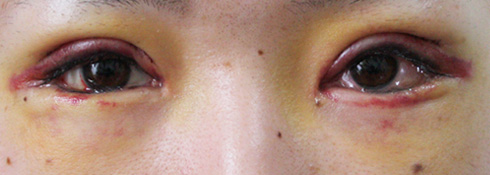 術後５日目 二重切開失敗 美容整形徒然日記