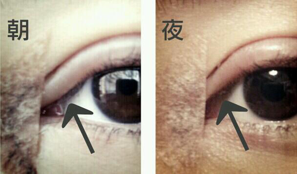 4日目 整形経過blog