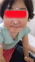 水疱瘡がーる