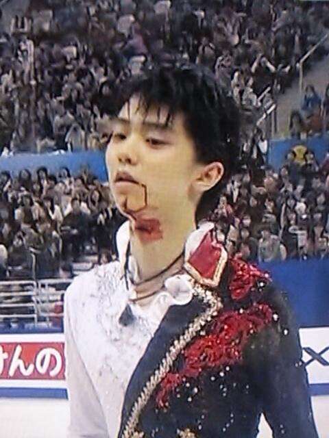 羽生結弦激突し負傷 2ちゃん芸能ニュース 羽生結弦激突し負傷 2ちゃん芸能ニュース