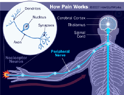 cipa-pain-diagram