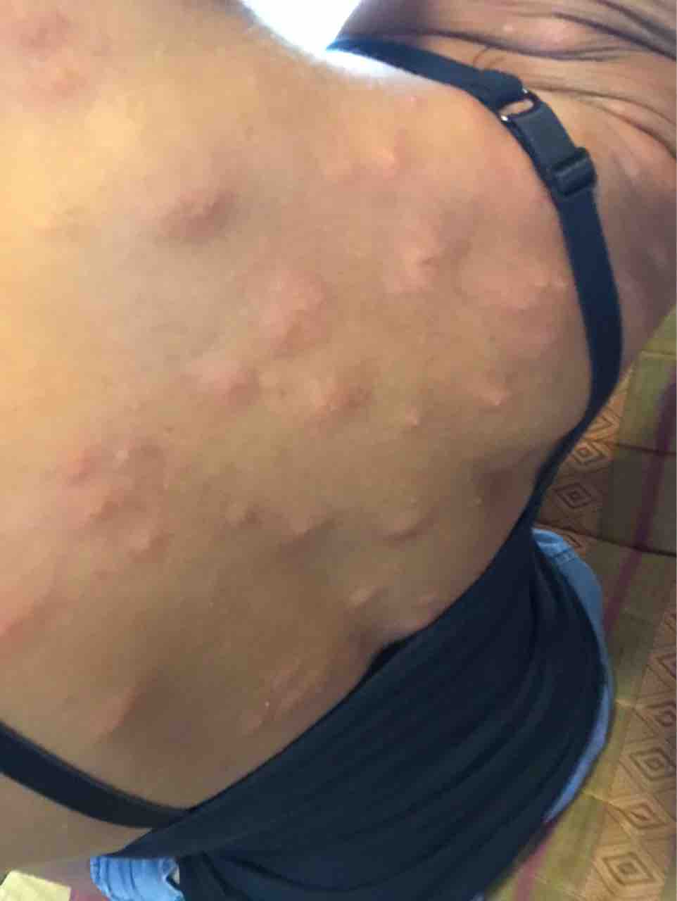 虫刺されにグリーンクレイパック Utariutari 虫刺されにグリーンクレイパック Utariutari
