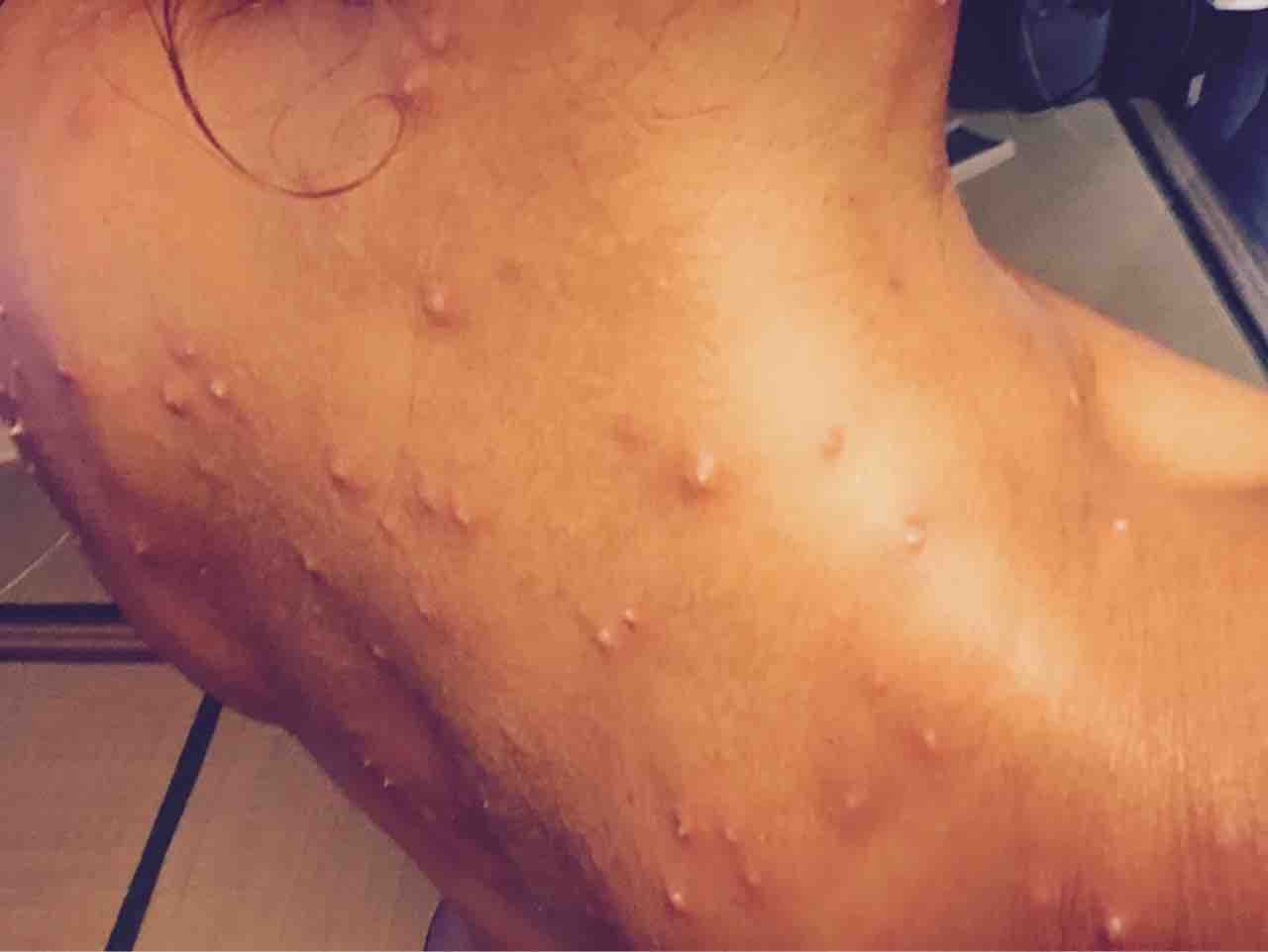 虫刺されにグリーンクレイパック Utariutari 虫刺されにグリーンクレイパック Utariutari