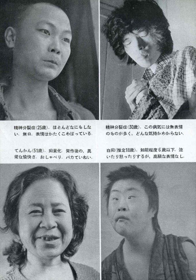 統合失調症顔つき, 統合失調症者の顔の特徴 – BETE