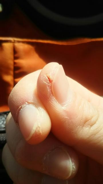 パックリ割れて しみるわ痛むわ 空色のちびまめ パックリ割れて しみるわ痛むわ 空色のちびまめ