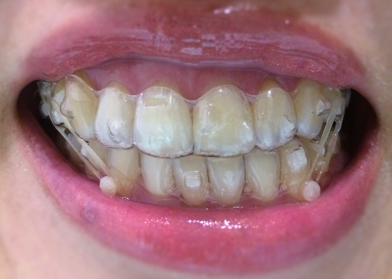 アライナー 10 16 40代からのインビザライン歯科矯正記録