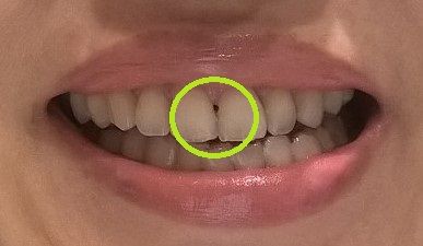 すぐ消えたブラックトライアングル 40代からのインビザライン歯科矯正記録 すぐ消えたブラックトライアングル 40代からのインビザライン歯科矯正記録