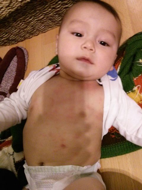 モントリオール生活 赤ちゃんの食物アレルギー モントリオール生活 赤ちゃんの食物アレルギー