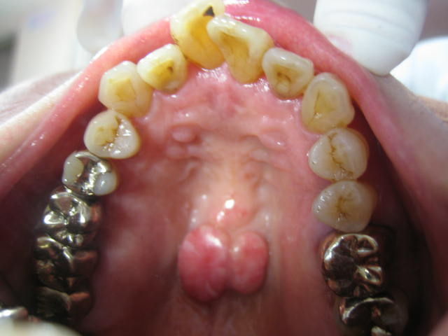 骨隆起 : 世田谷区千歳船橋、桜丘で開業している村田歯科診療日記