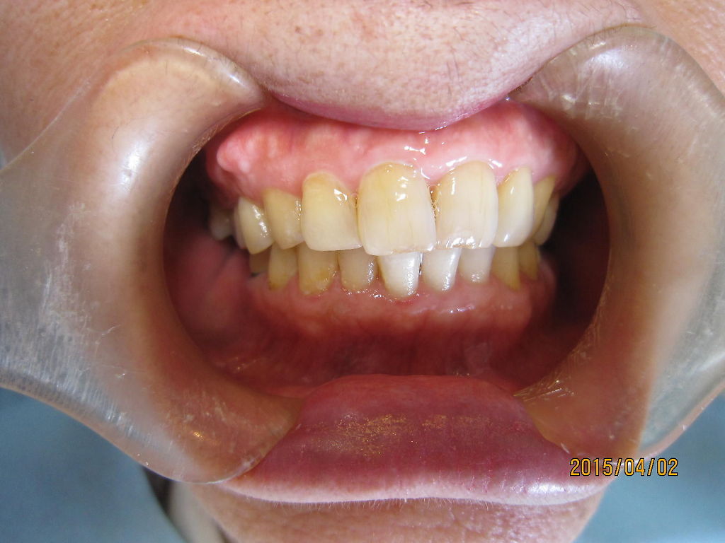 骨隆起 : 世田谷区千歳船橋、桜丘で開業している村田歯科診療日記