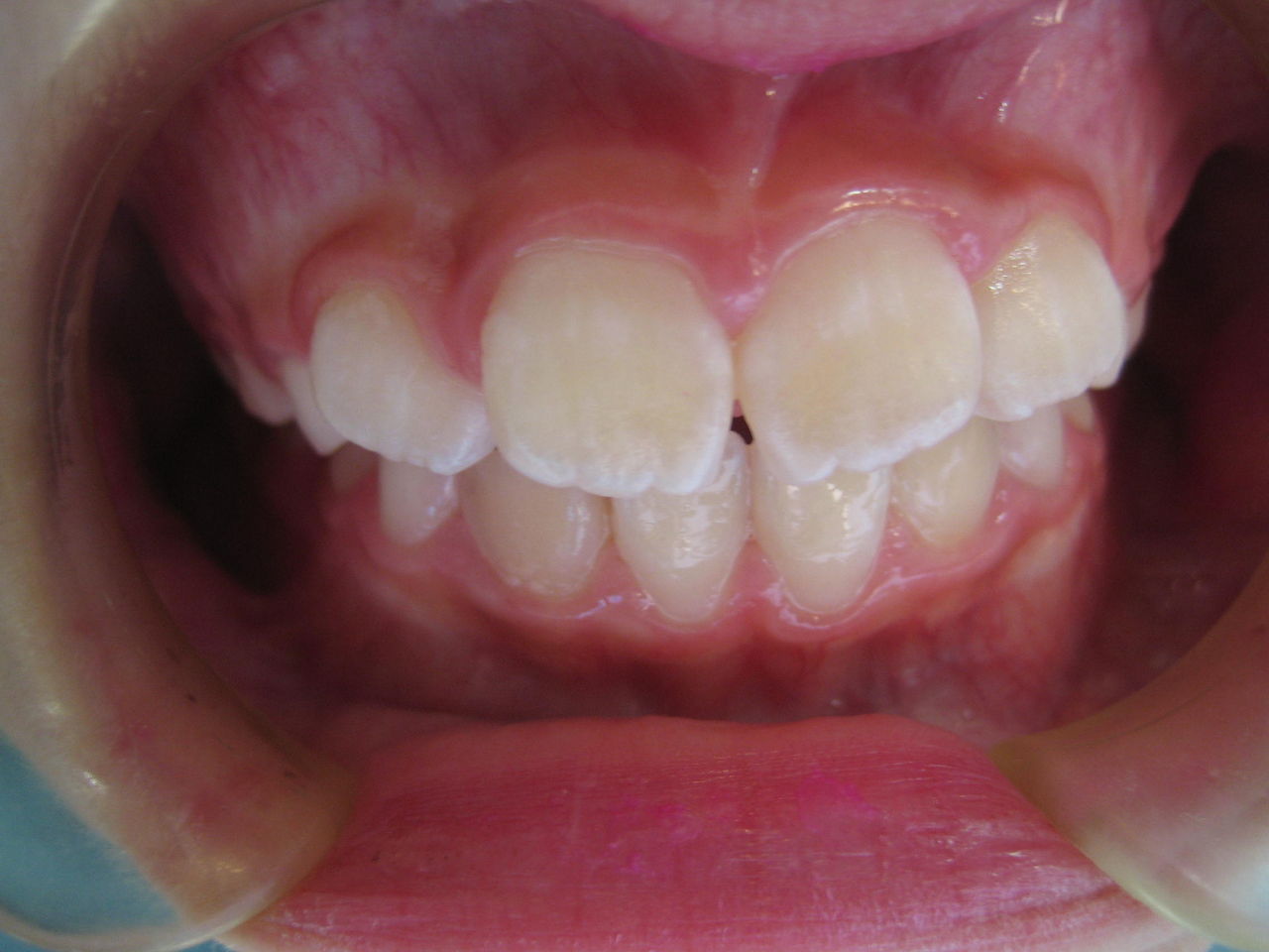 巨大歯 世田谷区千歳船橋 桜丘で開業している村田歯科診療日記