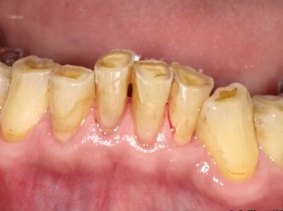 bruxism