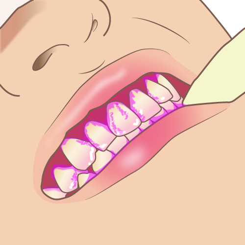 dental_disclosing_solution_3
