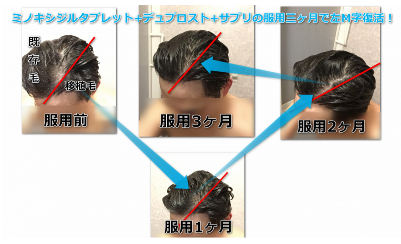 左m字の前髪が後退して抜ける場合に効く育毛剤があります 左m字前髪後退に効果を発揮する育毛剤アイテムとは 左m字の前髪が後退して抜ける場合に効く育毛剤があります 左m字前髪後退に効果を発揮する育毛剤アイテムとは