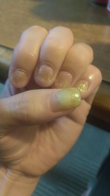 爪甲剥離症の爪は 割れたら補強もクソも何も効かねえんじゃねえの 神崎 ぼやきます