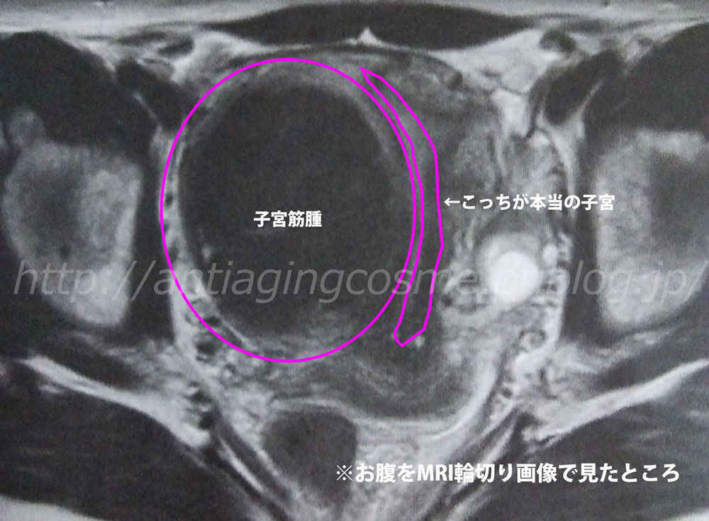 子宮筋腫の手術を受けてきました その2 自分おもて なし アンチエイジング日記 きれいマダムを目指して