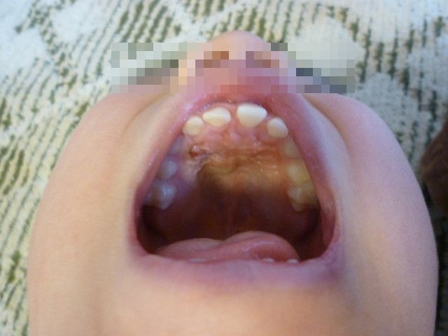 ごーすけ 過剰歯切除後の抜糸へ 転勤家庭の育児生活記