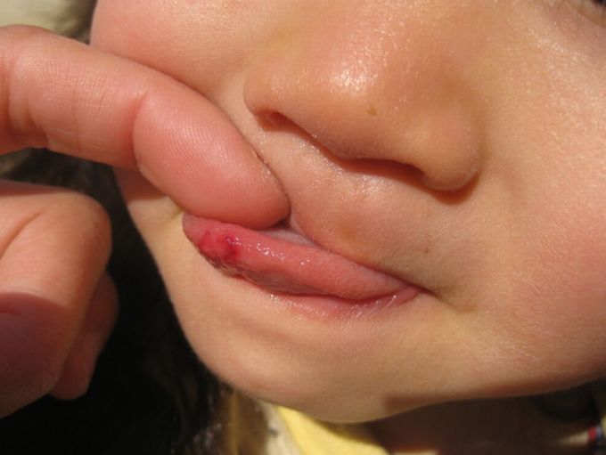噛ん 痛い 舌 だ 舌を噛んだときの正しい対処法を歯科医師が解説！｜歯科タウン