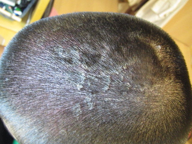 ごーすけ 頭の皮 転勤家庭の育児生活記