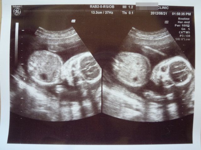 20週4日 第4回 妊婦検診 性別が分かる 妊娠から出産まで 転勤家庭 只今3人目妊娠中 20週4日 第4回 妊婦検診 性別が分かる 妊娠から出産まで 転勤家庭 只今3人目妊娠中