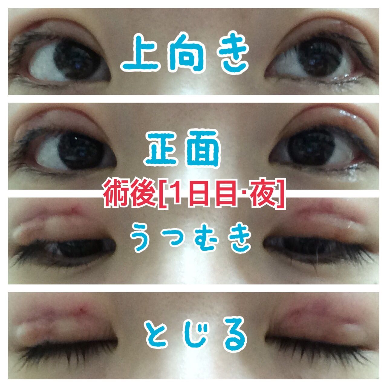 1日目 夜 埋没法 3点留め 私のおめめ事情 1日目 夜 埋没法 3点留め 私のおめめ事情