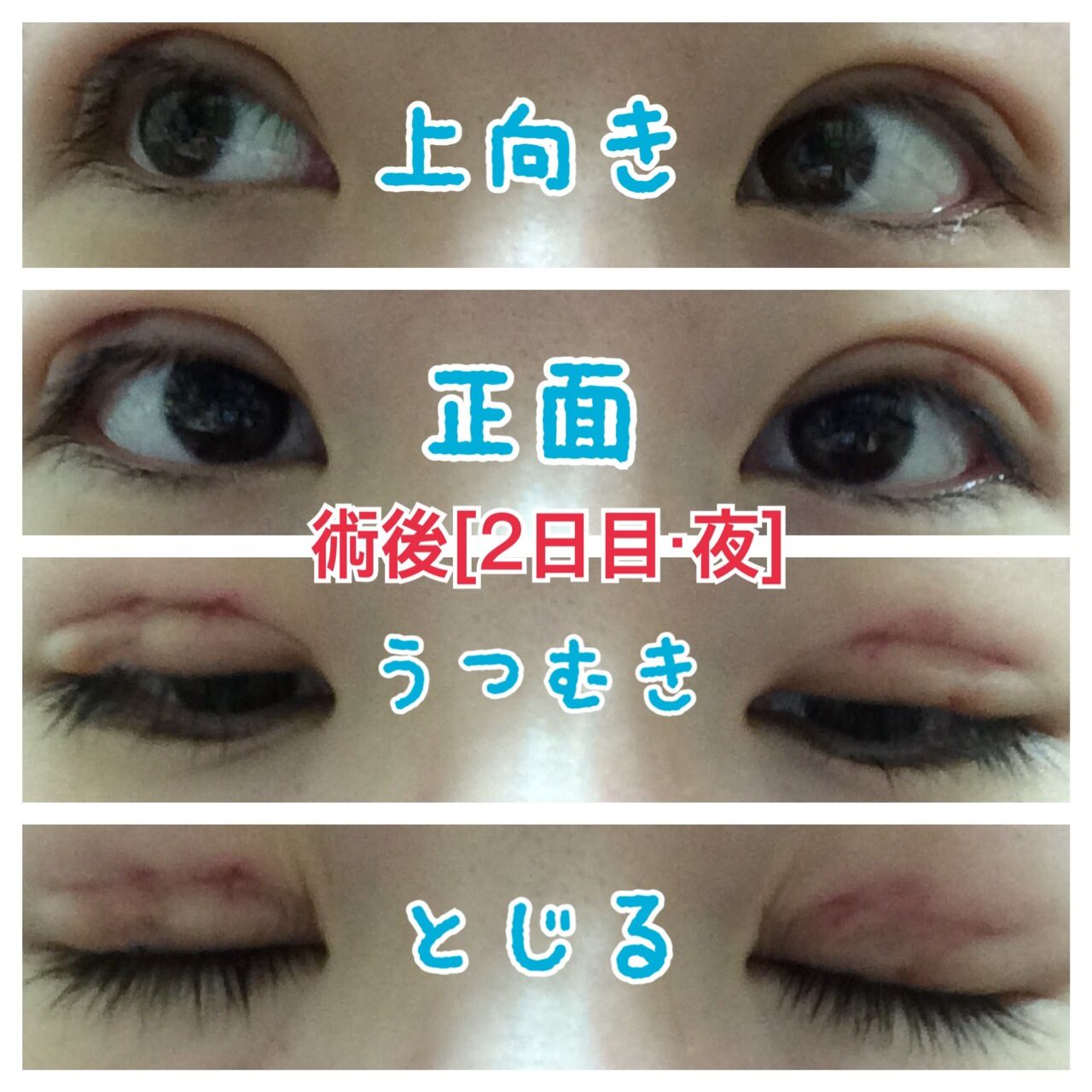 2日目 夜 埋没法 3点留め 私のおめめ事情 2日目 夜 埋没法 3点留め 私のおめめ事情