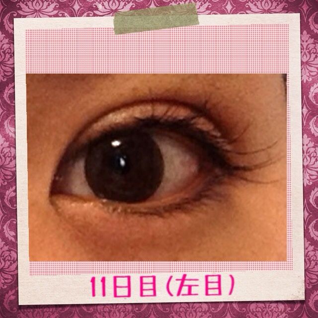 11日目 まいの二重整形 埋没術後経過blog 11日目 まいの二重整形 埋没術後経過blog