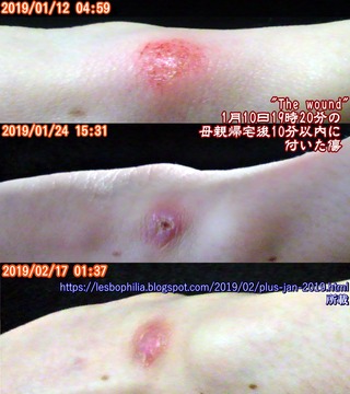 thewound