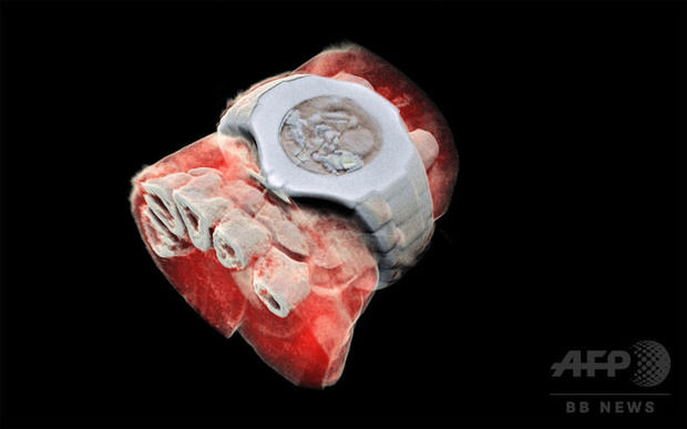 人体の3DカラーX線写真の撮影に成功