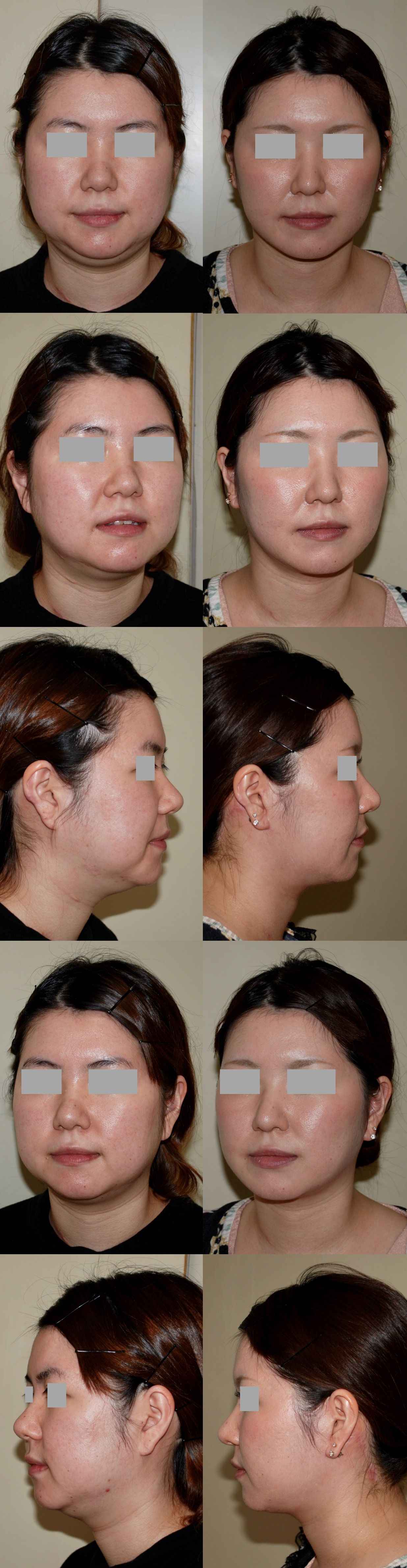 美容形成外科医dr 牧野のblog 鼻の美容外科