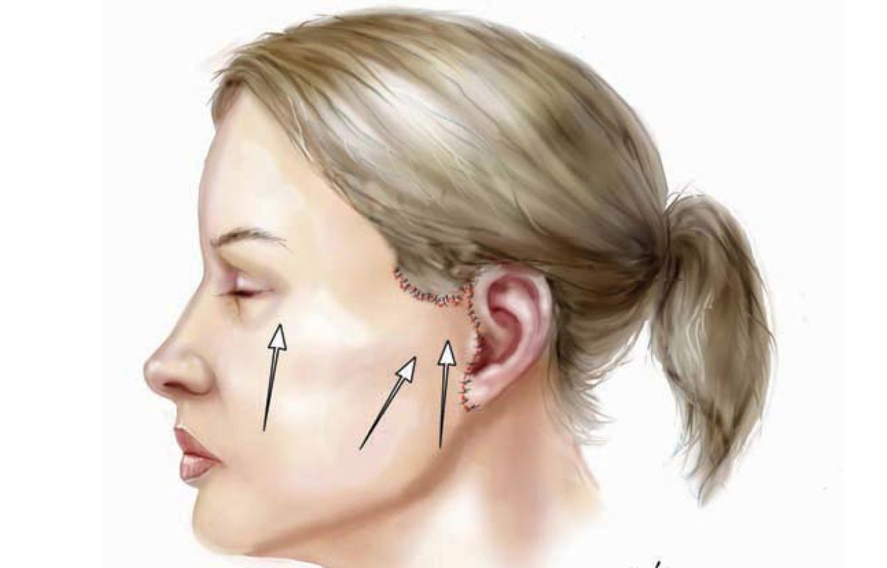 フェイスリフト 効果は高く リスクは低く 美容形成外科医dr 牧野のblog