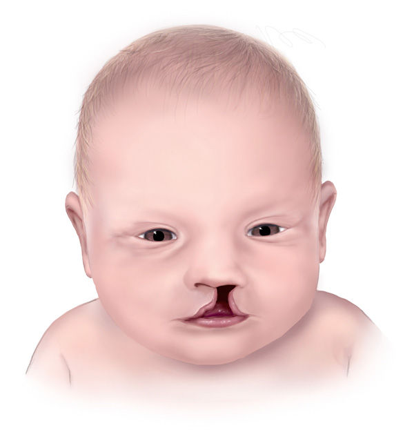 cleftlip