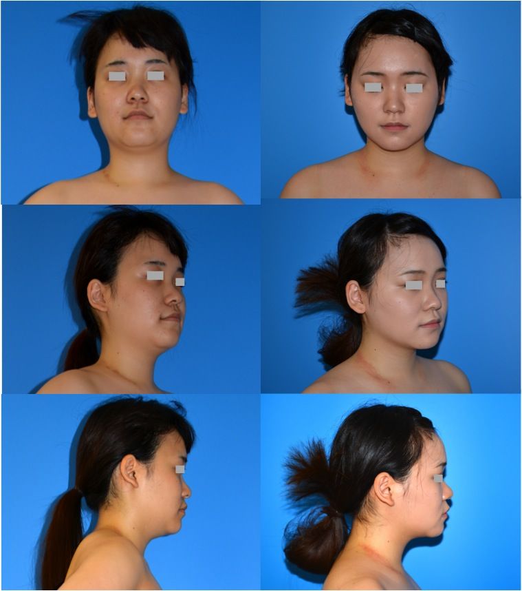 お顔の脂肪吸引のパーツモニターさま 美容形成外科医dr 牧野のblog