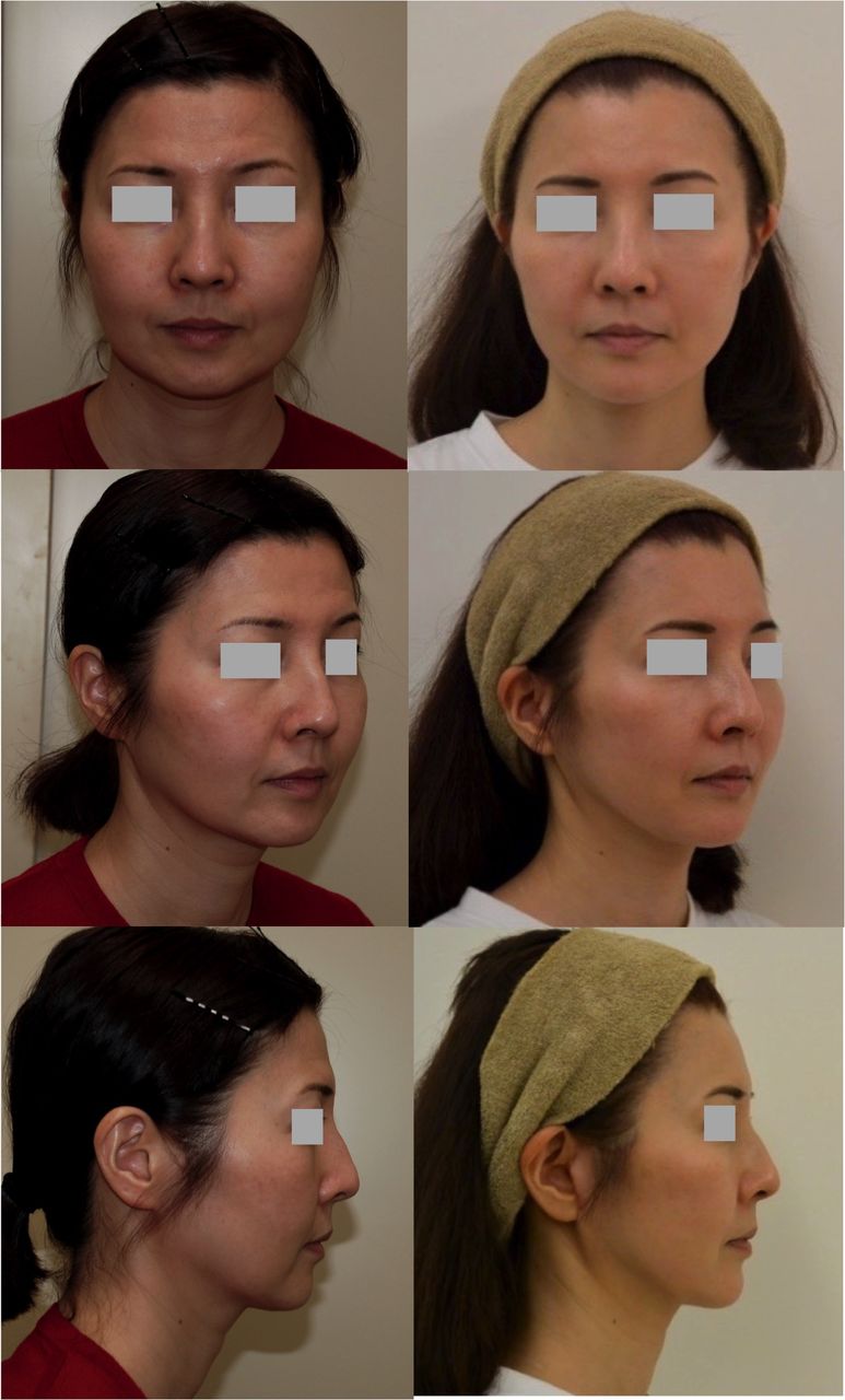 フェイスリフト Short Scar Facelift 前額 こめかみ 頬脂肪注入術のパーツモニターさま 美容形成外科医dr 牧野のblog