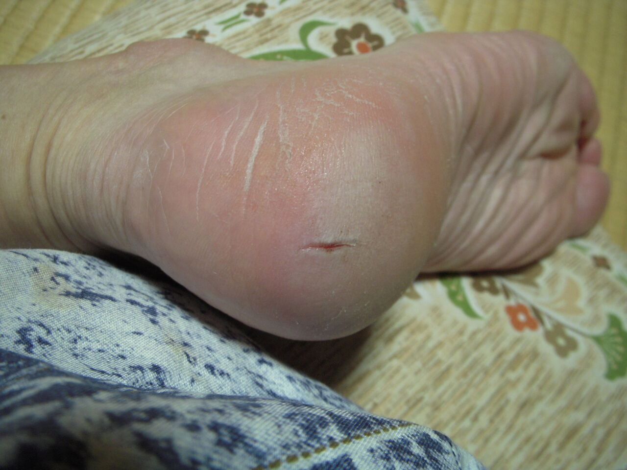 かかとの異常 ライダーのメモ帳 かかとの異常 ライダーのメモ帳