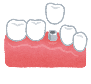 teeth_implant